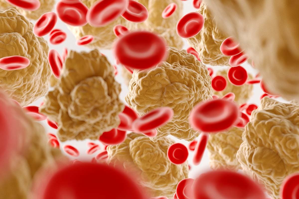 Analítica de sangre con valores de colesterol LDL marcados